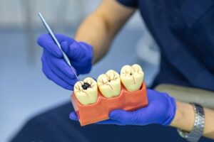 ALL ABOUT CAVITIES