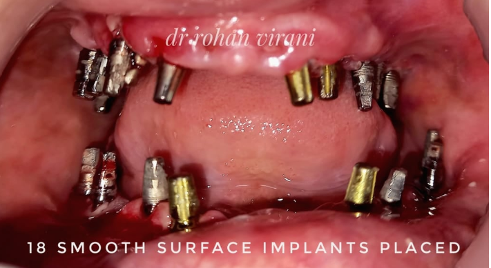 18-smooth-surface-implants-placed