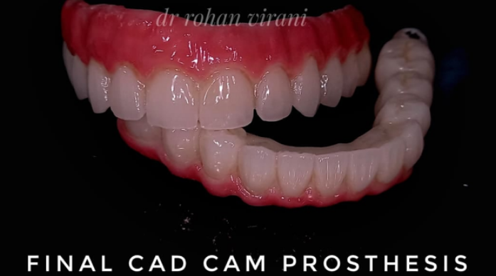 final-cad-cam-prosthesis-1