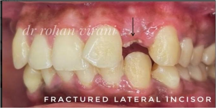 fracture-lateral-incisor