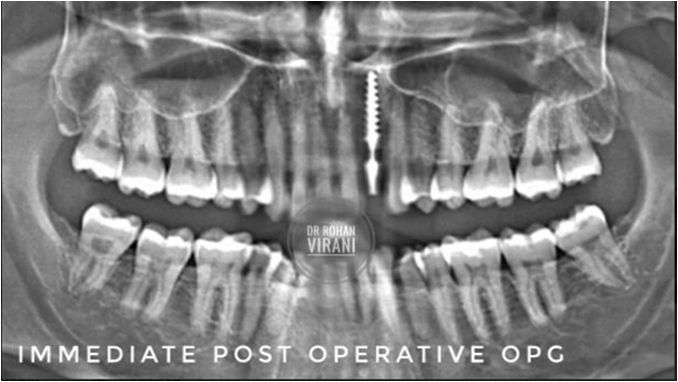 immediate-post-operative-radiographic