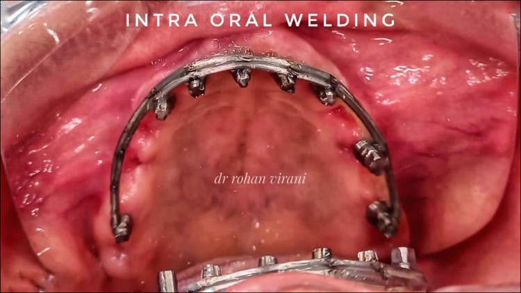 intra-oral-welding