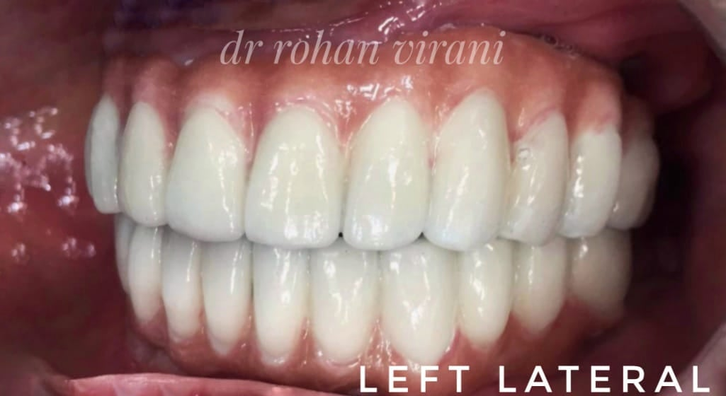 left-lateral-view-maxillary-and-mandibular-final-prosthesis