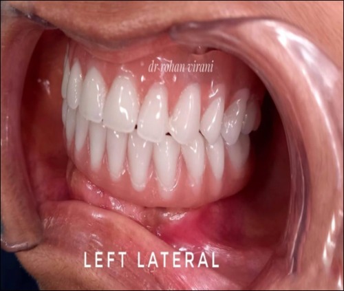 left-lateral