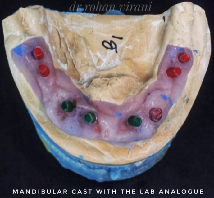 mandibular-cast-with-the-lab-analogue