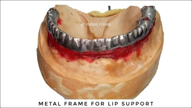 metal-frame-for-lip-support