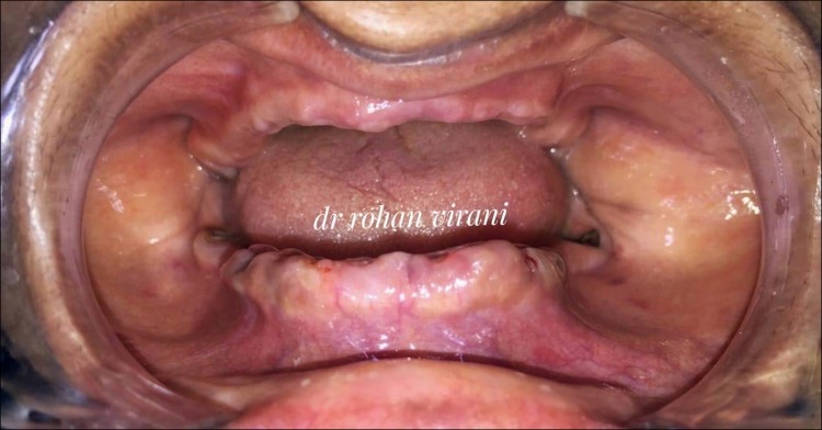 pre-operative-intra-oral