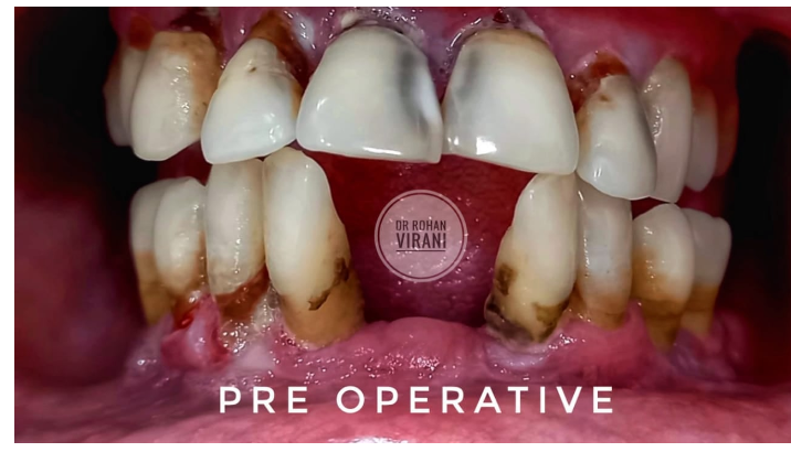 preoperative-intraoral-view