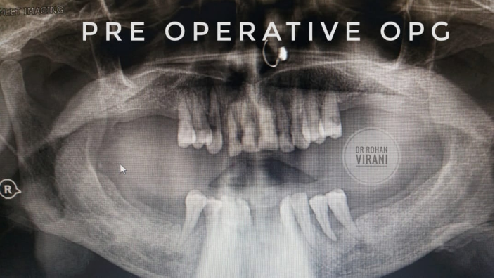 preoperative-radiographic-view-opg