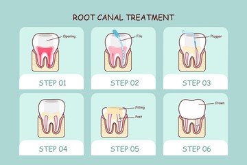 Root Canel Treatment