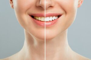 Teeth Whitening Treatment