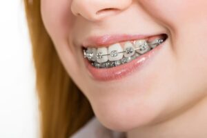 Conventional Braces and Their Advantages