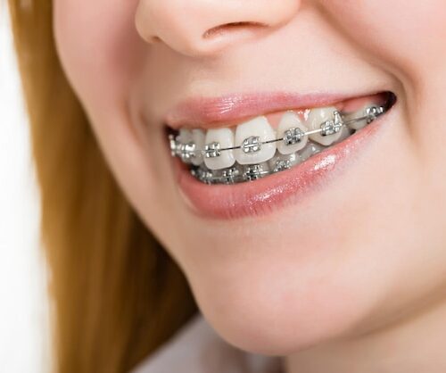 conventinal braces