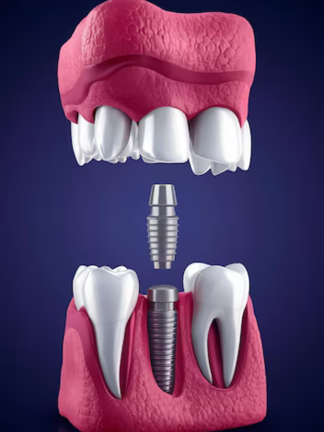 Basal OR Traditional Implant?