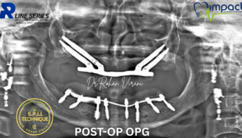 post op opg spil techinque