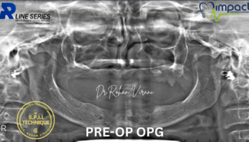 pre op opg spil technique